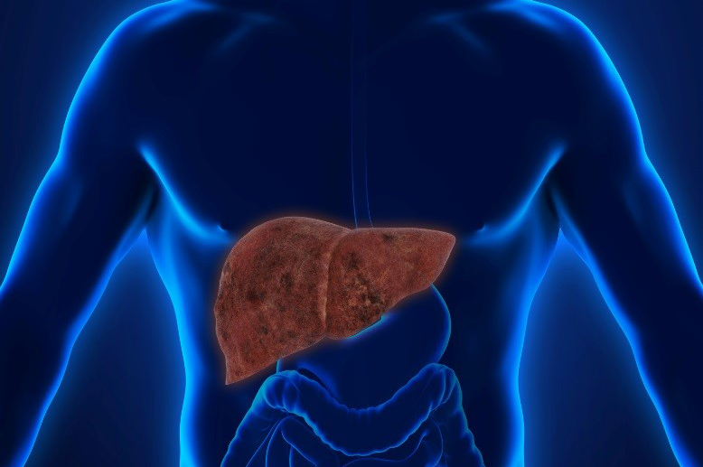 Fatty Liver Disease<br>Diagnostics