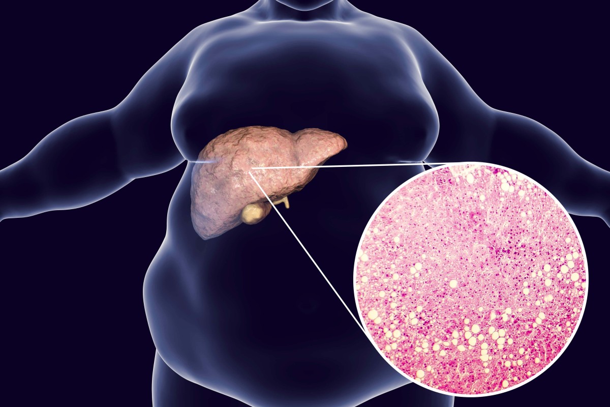 NAFLD